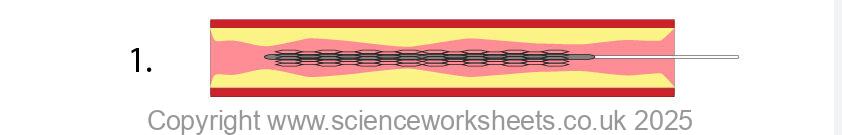 Using stents to open up an artery