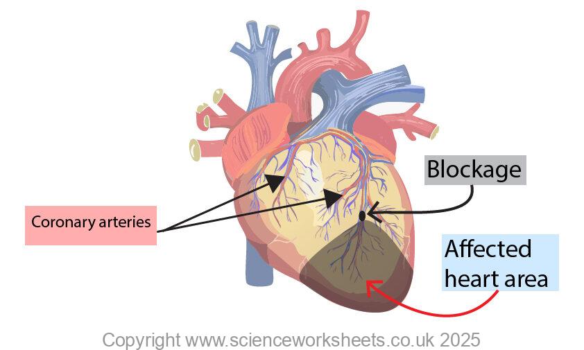 Coronary heart disease with a coronary artery blocked