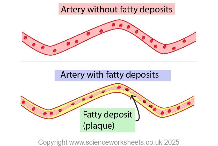 Coronary heart disease in blood vessels