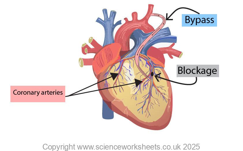 Bypass to correct coronary artery disease