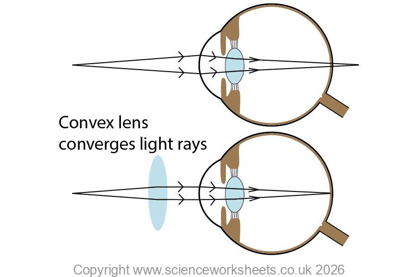 Hyperopia and how to correct it with a convex lens