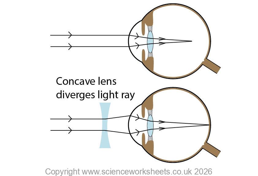 myopia and treatment